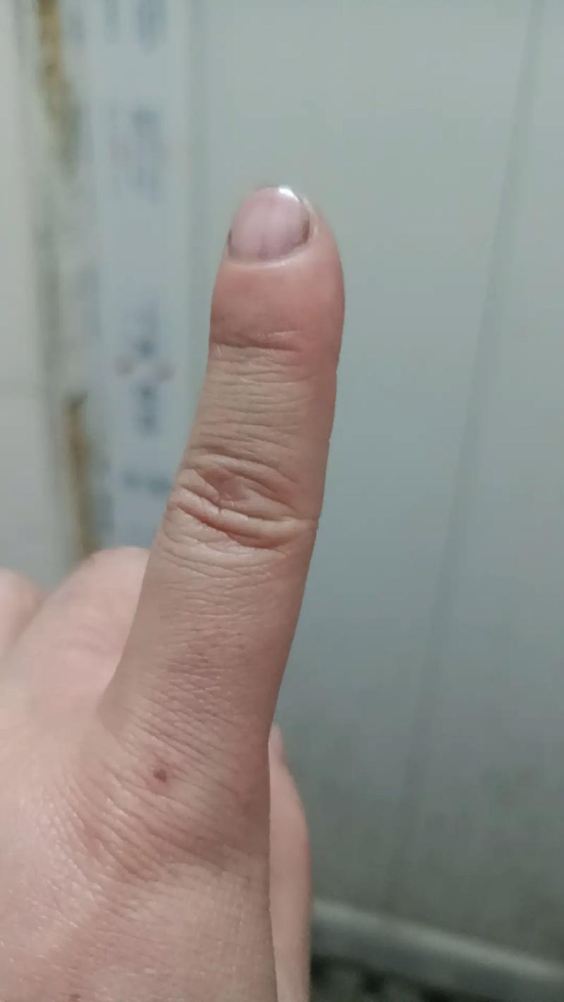 刷抖音手肿了什么原因