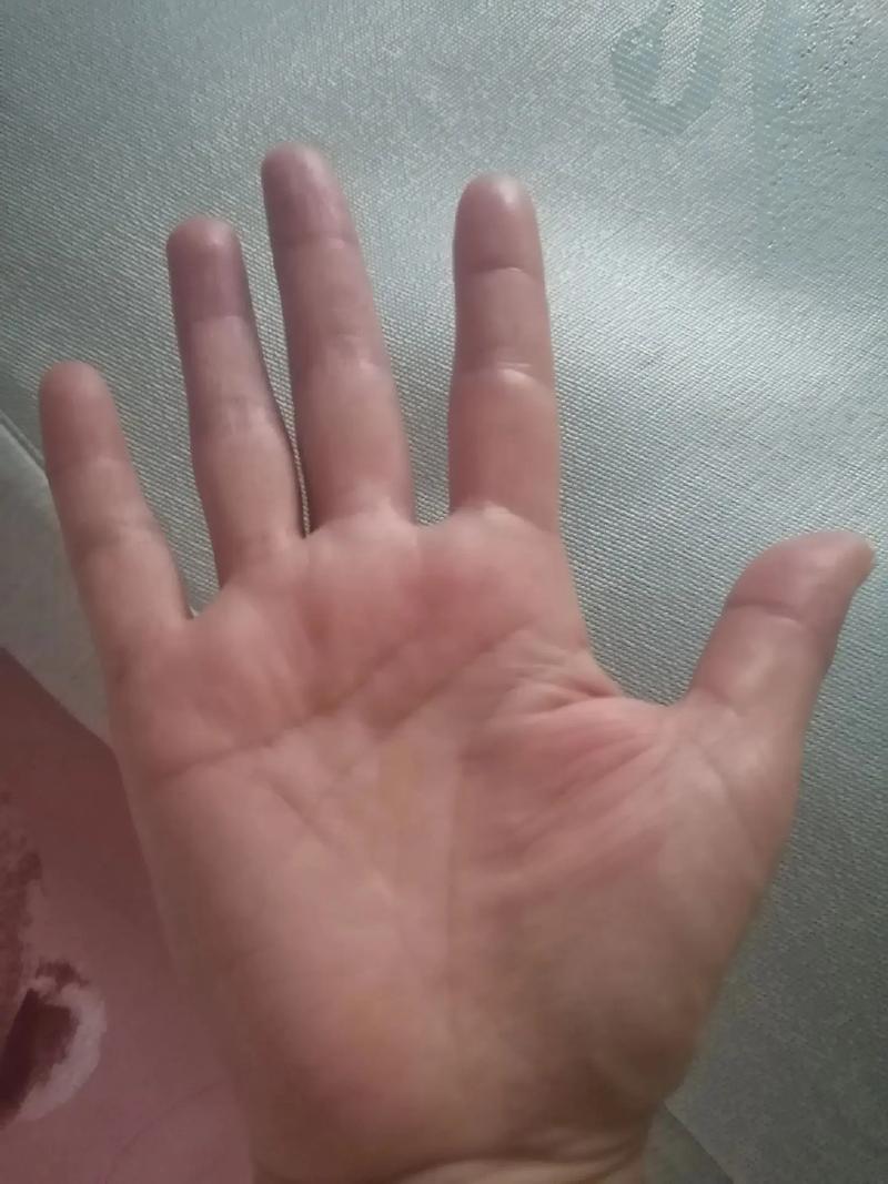 刷抖音手肿了什么原因