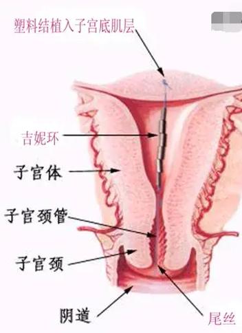 抖音为什么不能上环了呢