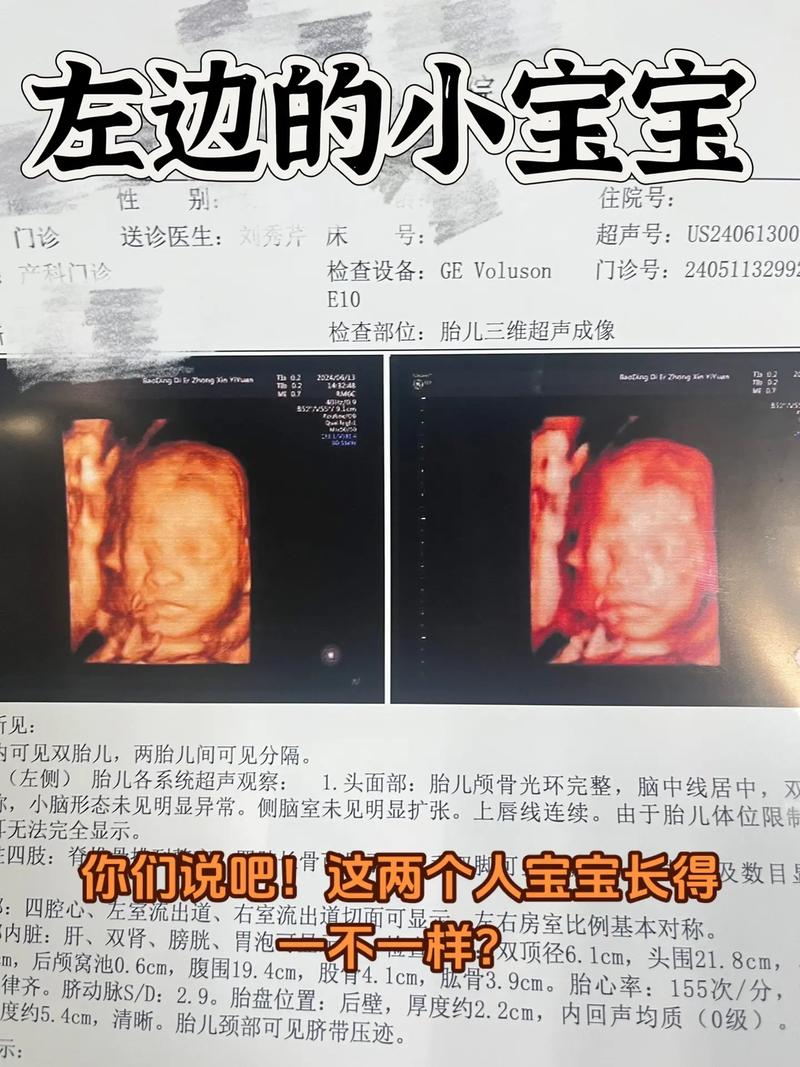 抖音双胞胎为什么分开住