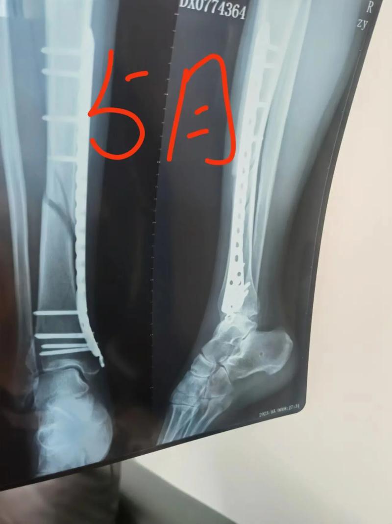 抖音腿断是什么意思呀