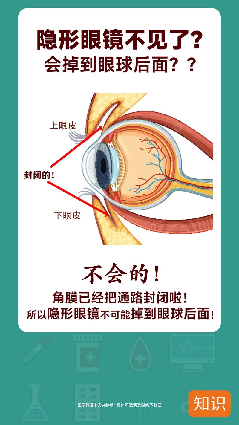 隐形眼镜怎么投千川？