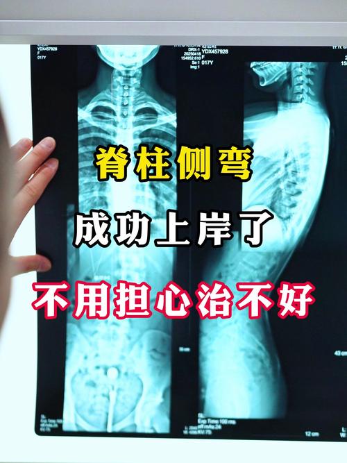 英国女孩“打飞的”来沪治脊柱侧弯