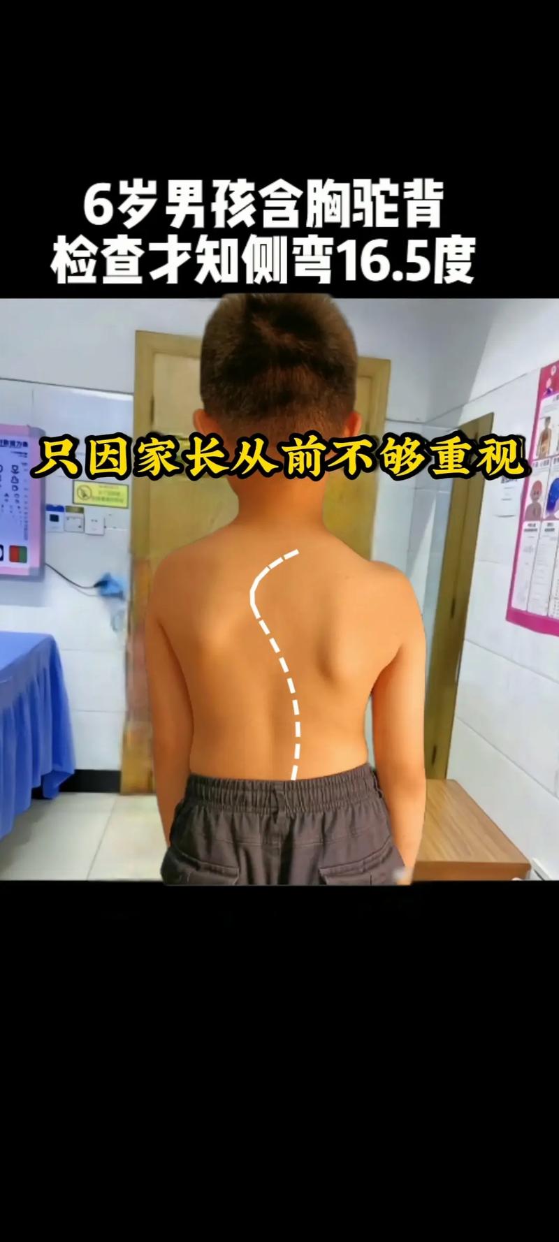 孩子坐姿不正，警惕脊柱侧弯风险
