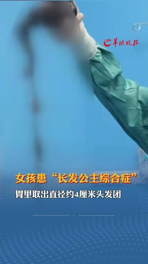 15岁少女吃头发成瘾胃里取出4斤发石