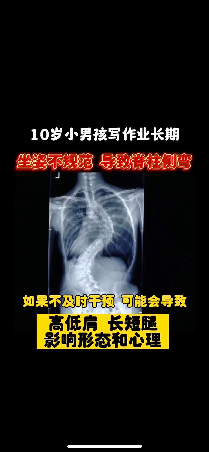 孩子“坐没坐相”可能是脊柱侧弯