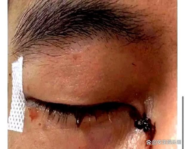 男子眼球被炸破 夏天很多人在用它