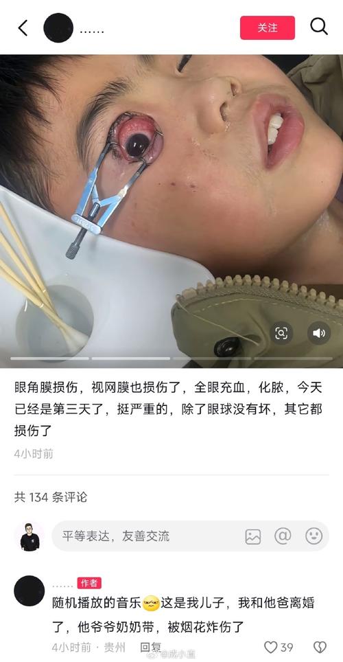 男子眼球被炸破 夏天很多人在用它