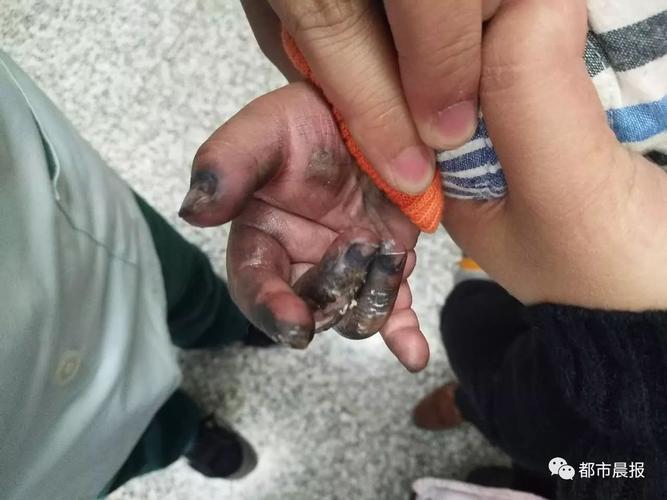 少年手指遭干冰炸裂伤，伤口触目惊心