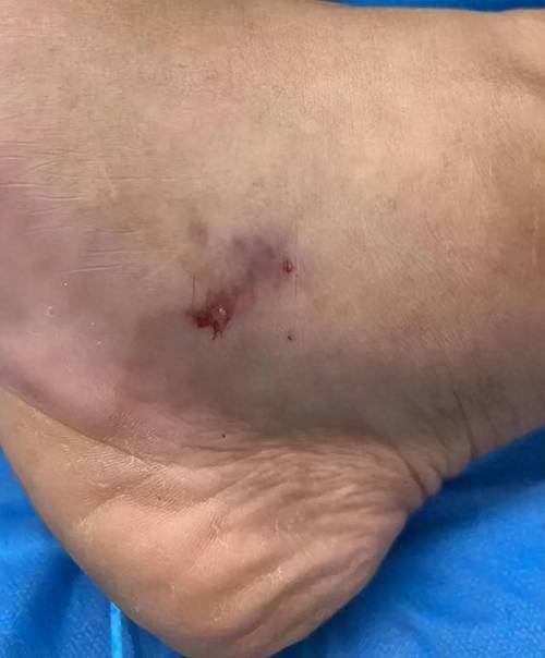 被蛇咬可以用嘴吸出毒血吗？