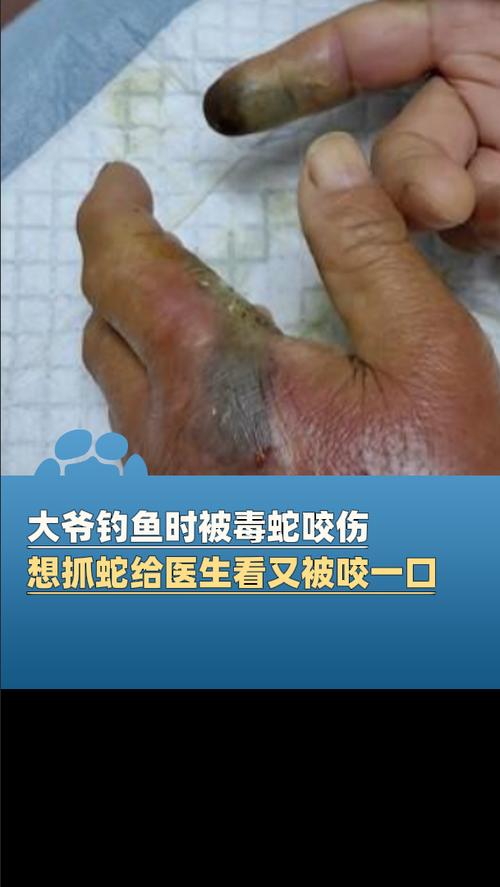 被两种蛇同时咬伤的大叔血清过敏