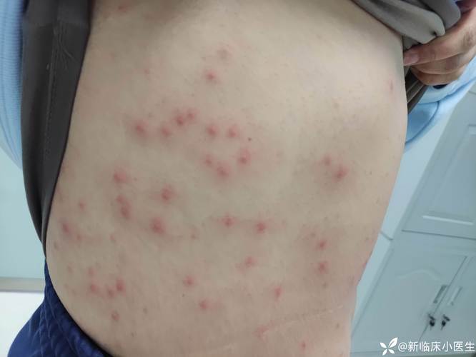 出现这些症状可能是基孔肯雅热