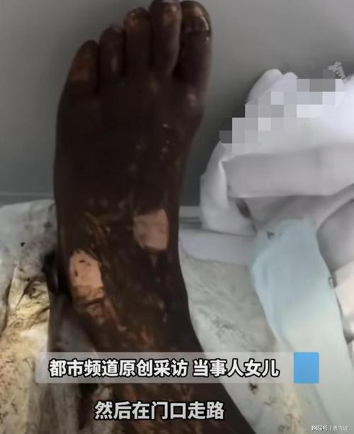 大叔遭两种蛇咬伤后出现血清过敏反应