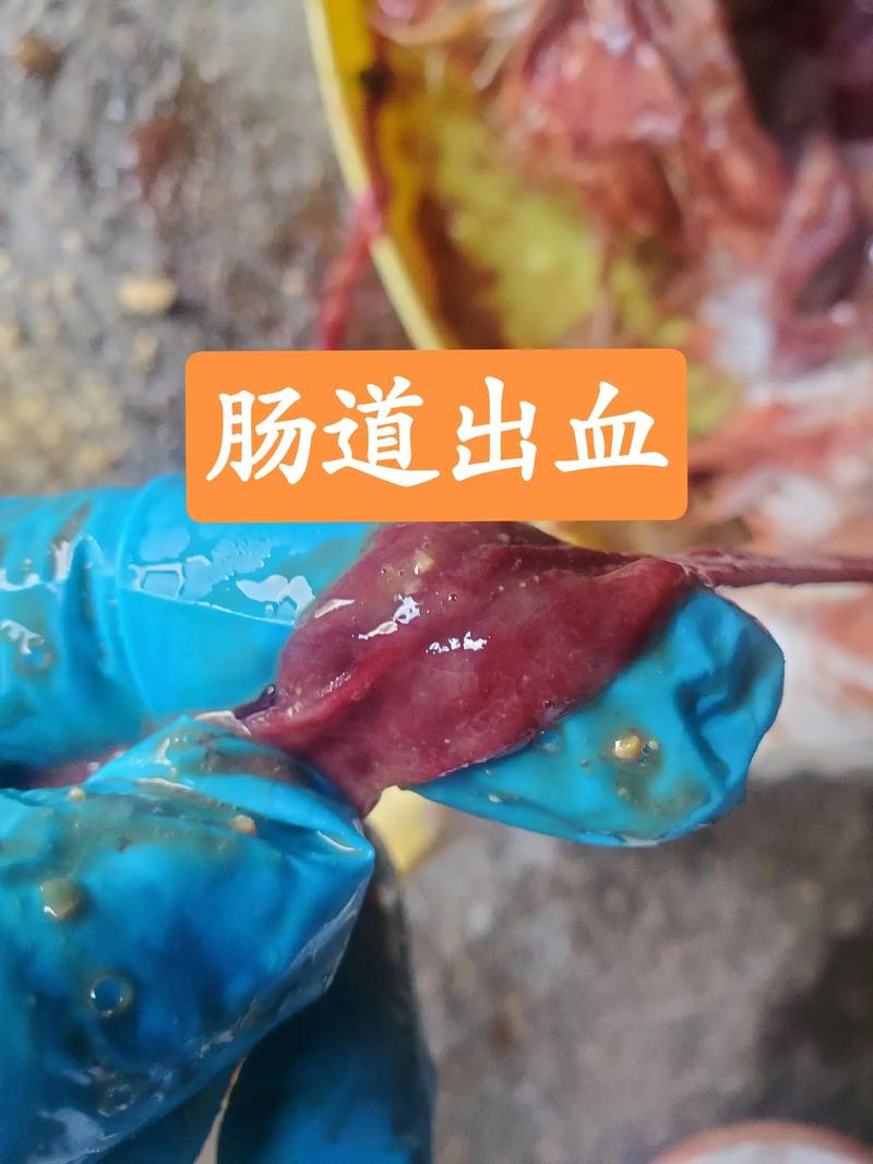 小伙因嗜辣引发肠道大出血