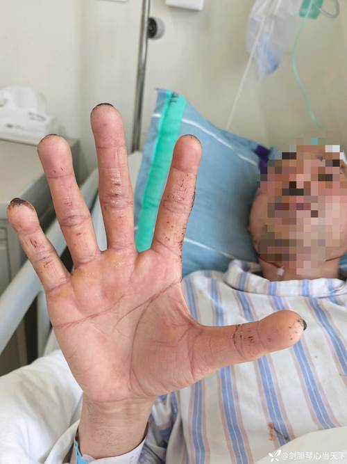 男孩赶14小时作业双手痉挛变鸡爪状