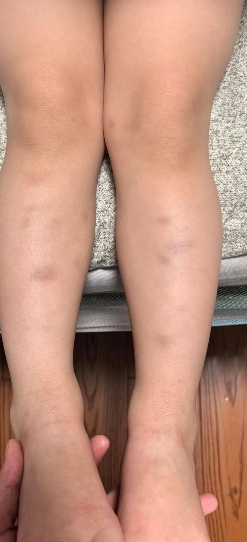女生身体更容易出现淤青的原因探究