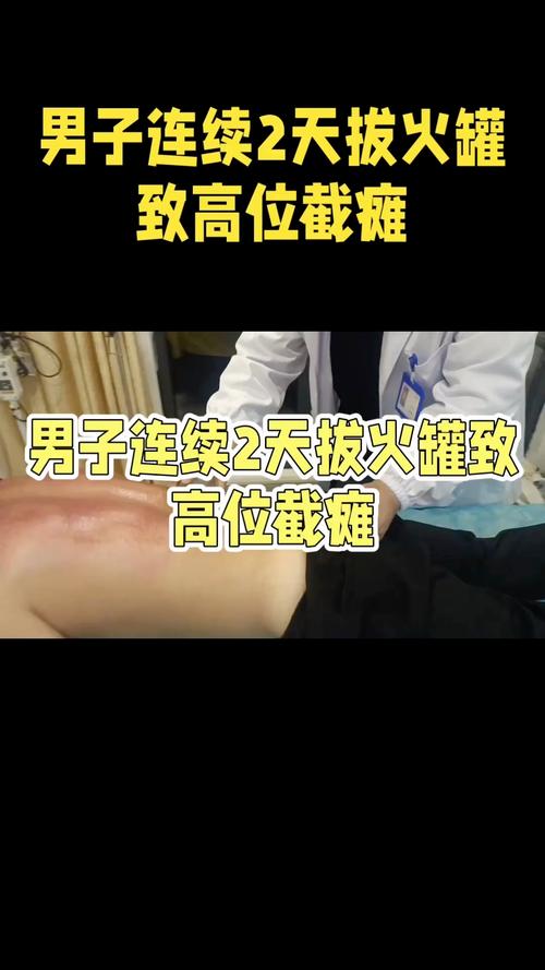 男子连续两天在家拔火罐引发高位截瘫