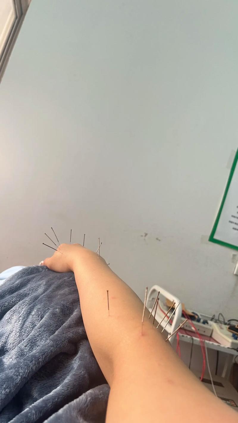 为了更熟练 医学生在自己身上练针灸